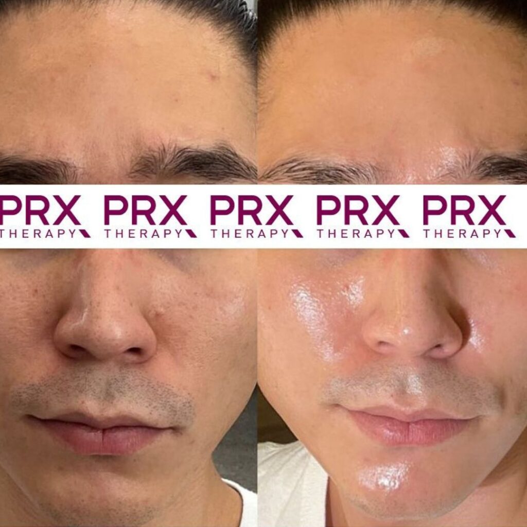 PRX before & after glow