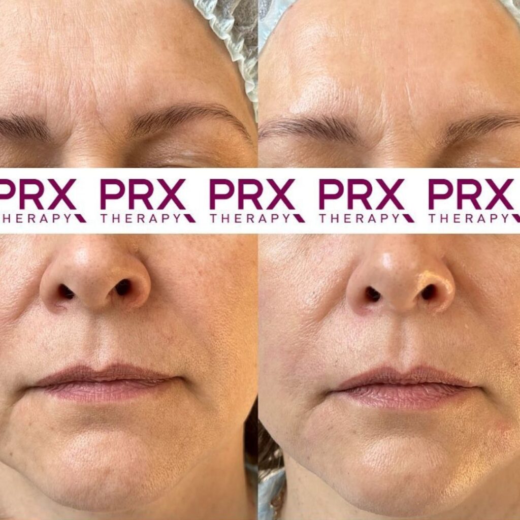 PRX before & after rimpel vermindering