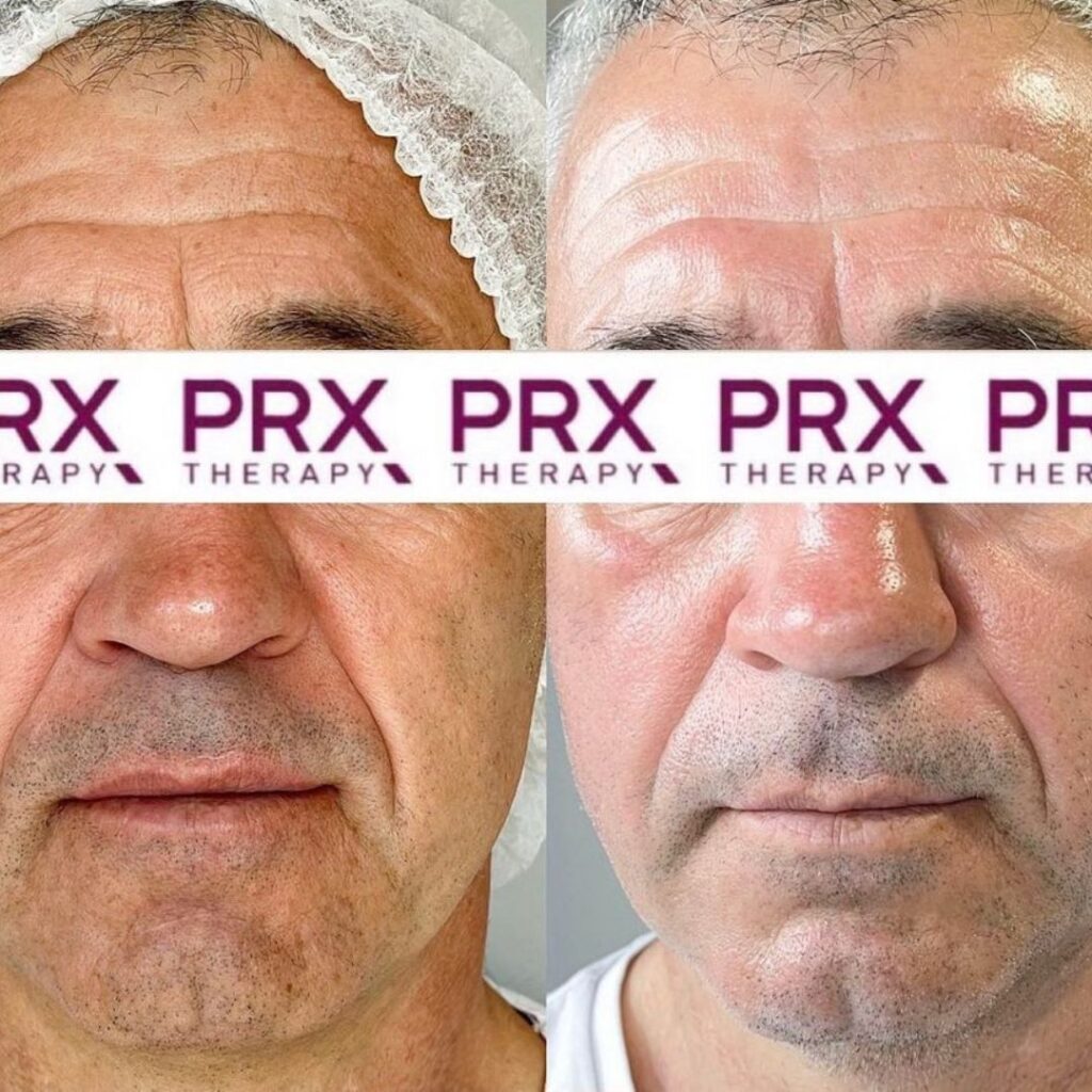 PRX-therapy before & after glow en diepe rimpels