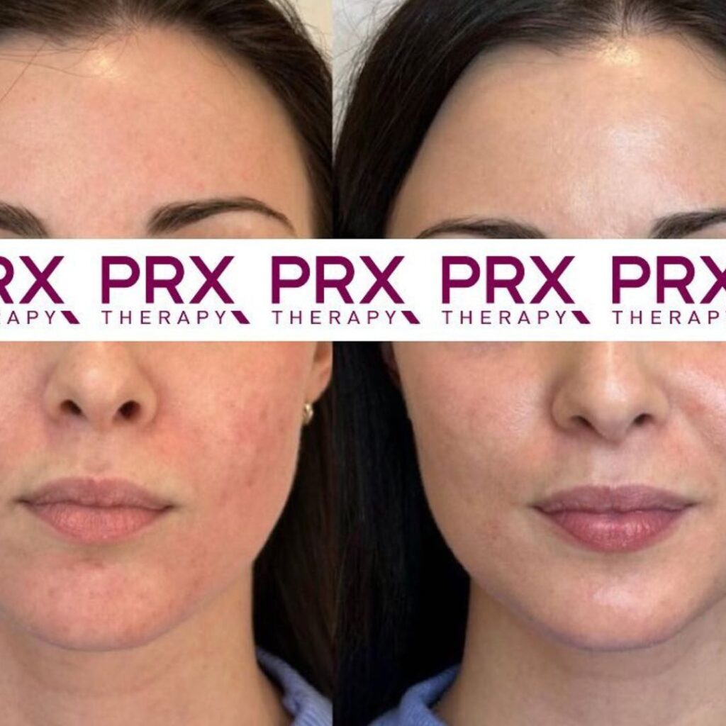 PRX-therapy before & after op roodheid en versteviging