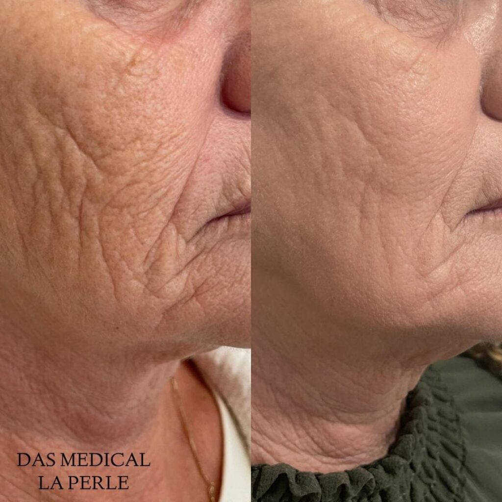 before & after das-plasma