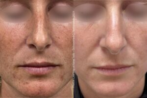 Before & After Alpha IPL Pigment