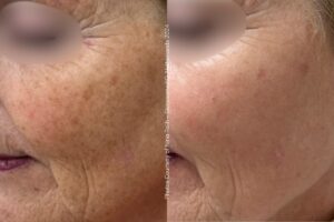 Before & After Alpha IPL Pigmentatie