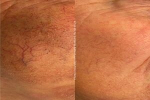 Before & After Alpha IPL Rosacea wang