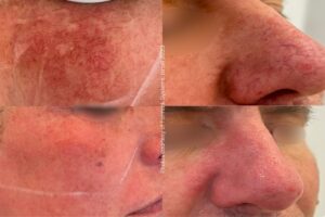 Before & After Alpha IPL Rosacea wang & gezicht