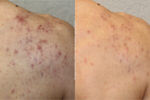 Before & After Alpha IPL acne vulgaris rug