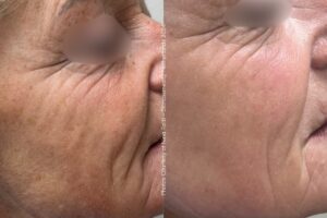Before & After Alpha IPL houdveroudering met Tight & Bright