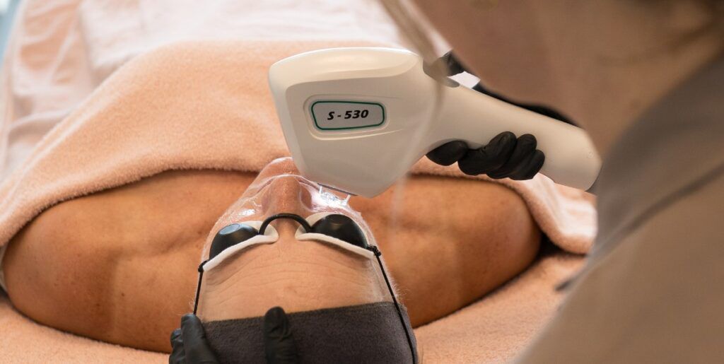 IPL behandeling met Alpha