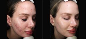 Voor- en na foto exosomen acne