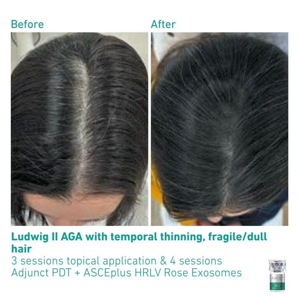 ASCEplus HRLV B&A AGA