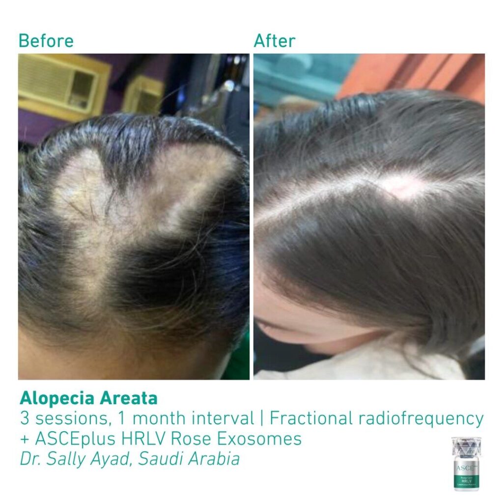 ASCEplus HRLV B&A Alopecia Areata