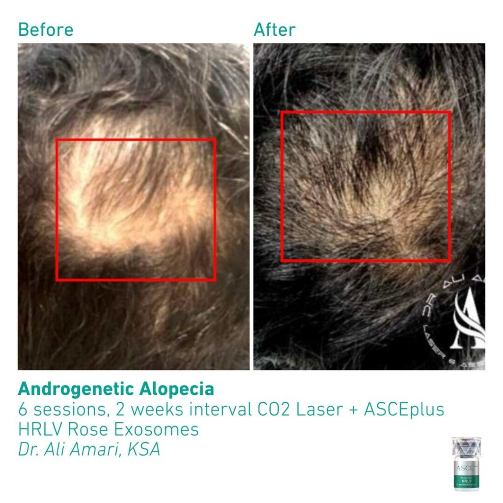 ASCEplus HRLV B&A Androgenetic Alopecia