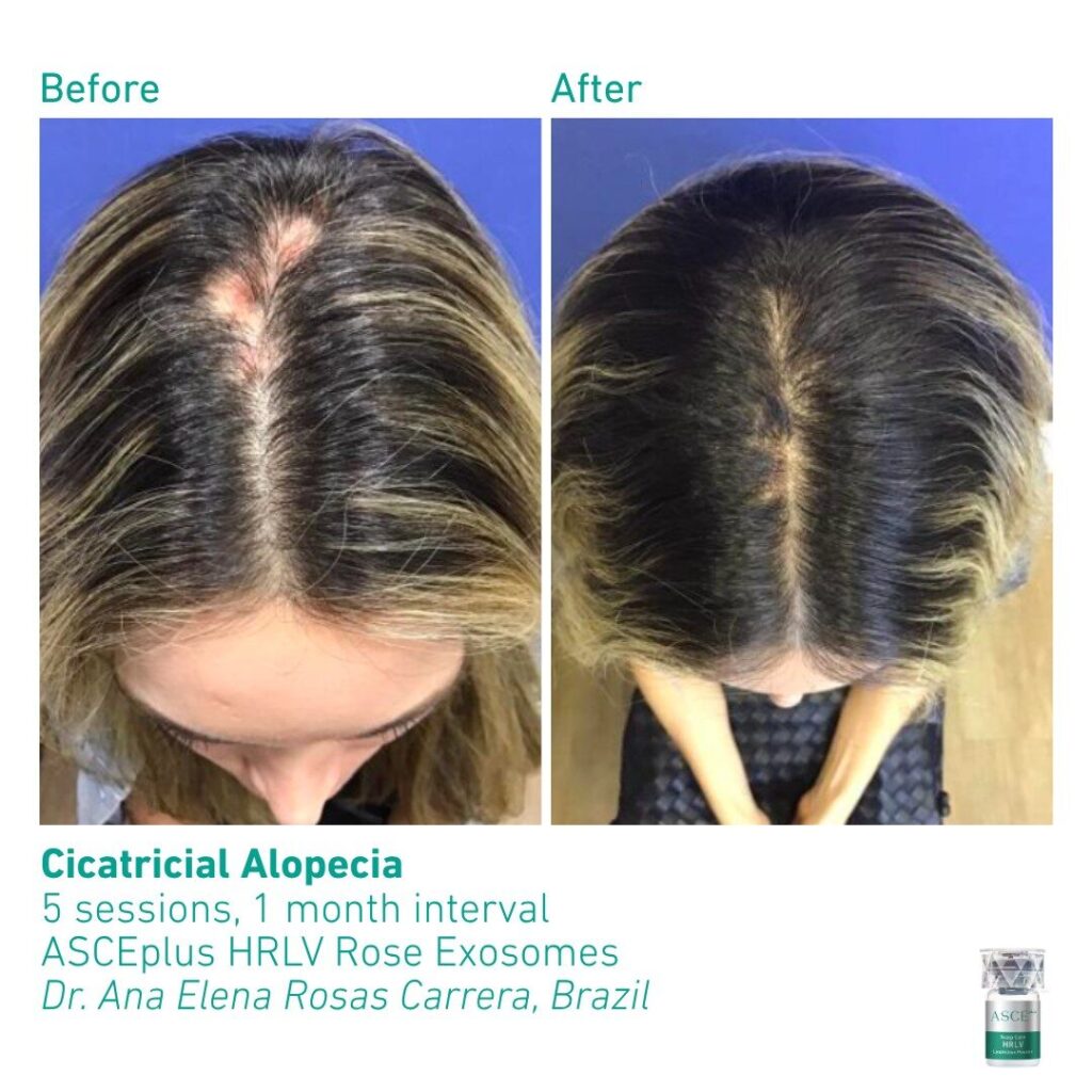 ASCEplus HRLV B&A Cicatricial Alopecia