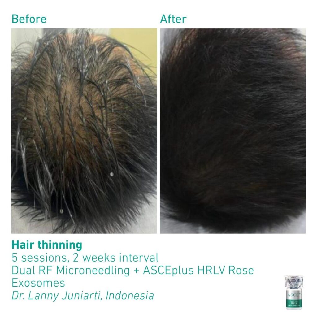 ASCEplus HRLV B&A Hair Thinning