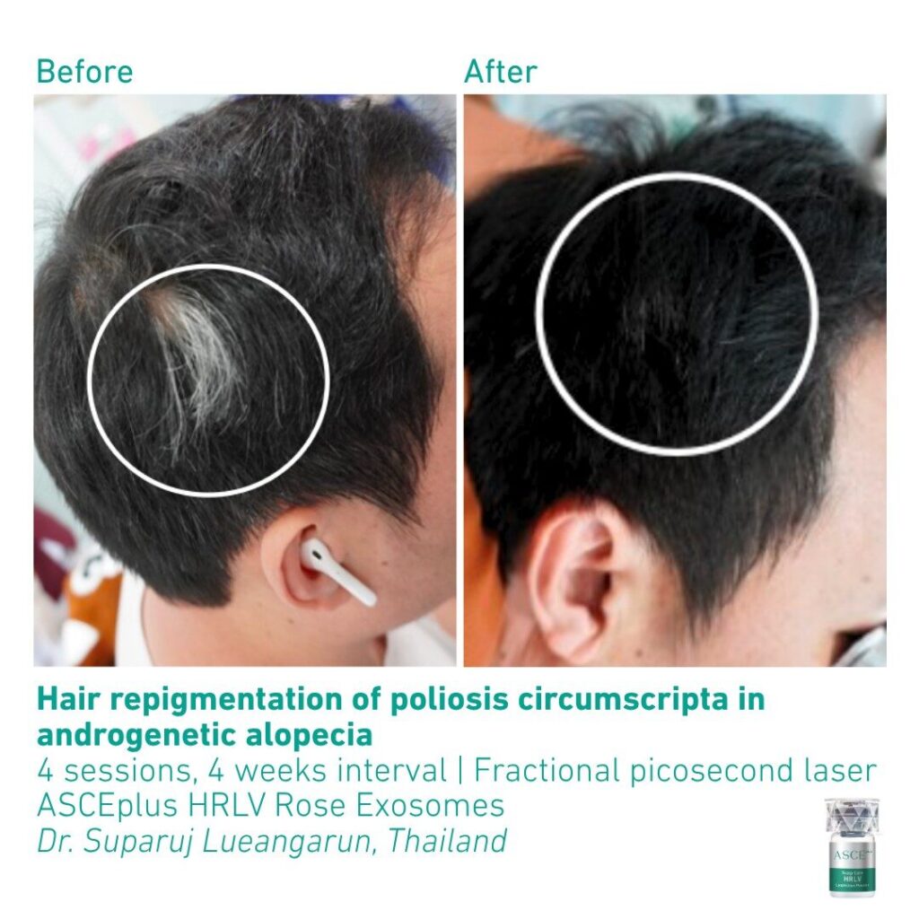 ASCEplus HRLV B&A Repigmentation