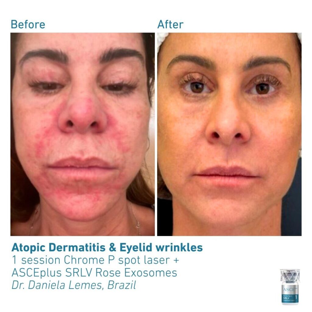 ASCEplus SRLV B&A Atopic Dermatitis & Eyelid Wrinkles