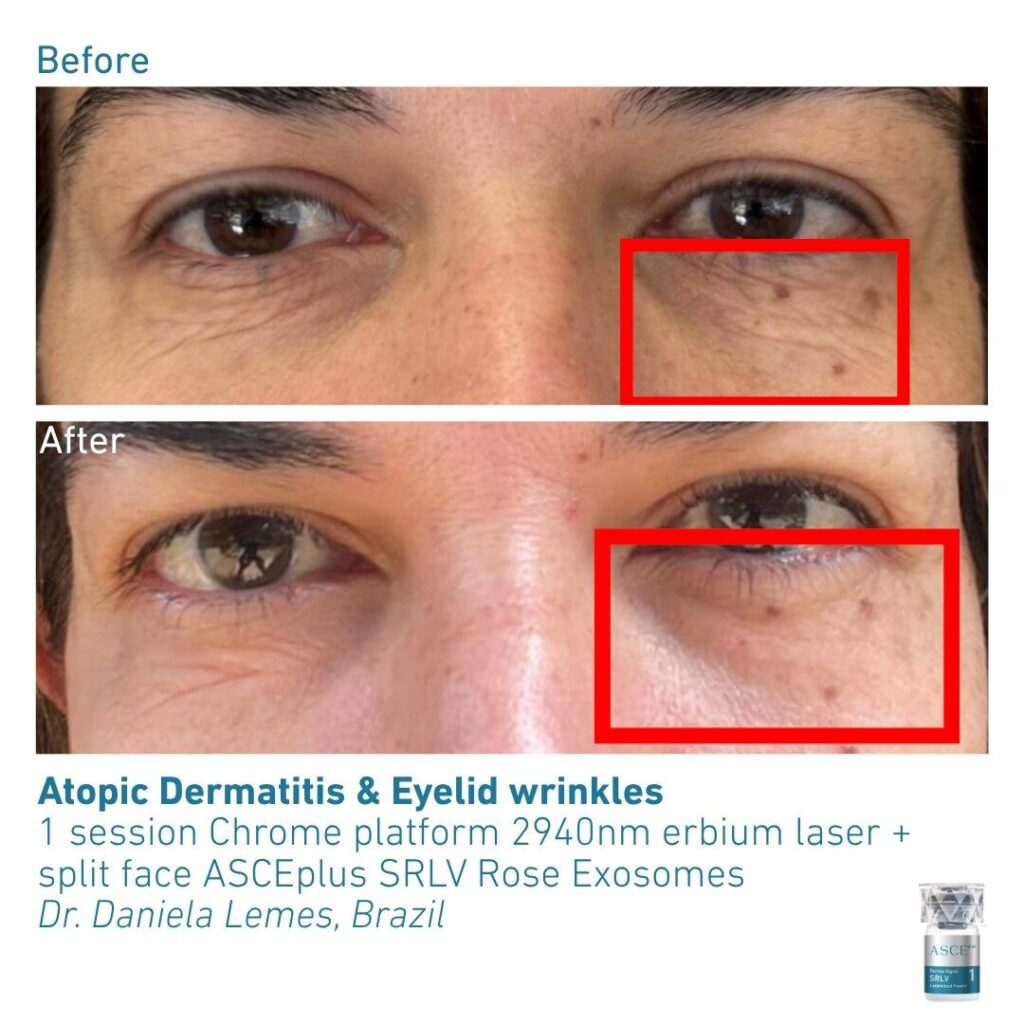 ASCEplus SRLV B&A Dermatitis & Eyelid Wrinkles