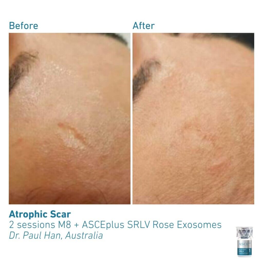 ASCEplus SRLV B&A Atrophic Scar