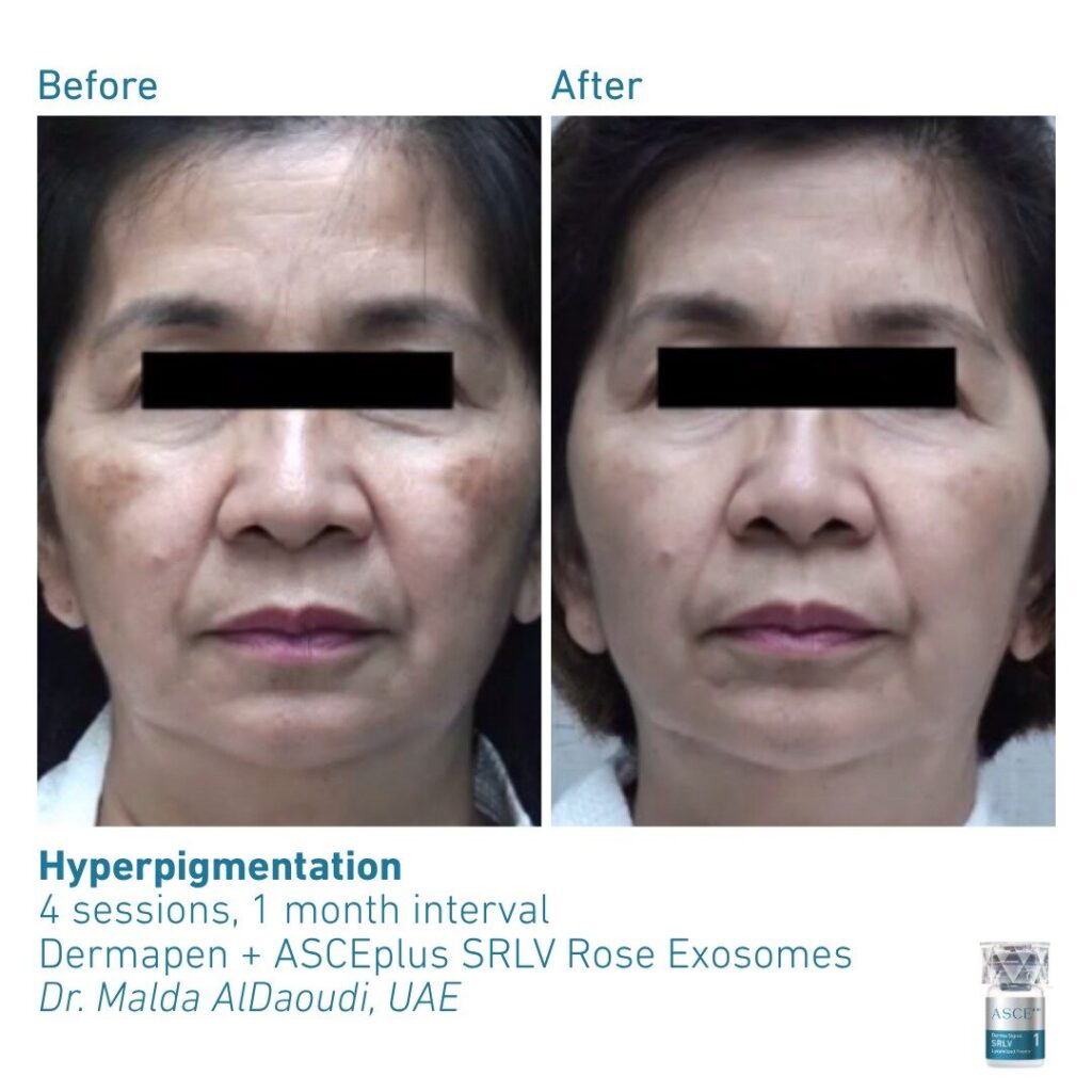 ASCEplus SRLV B&A Hyperpigmentation