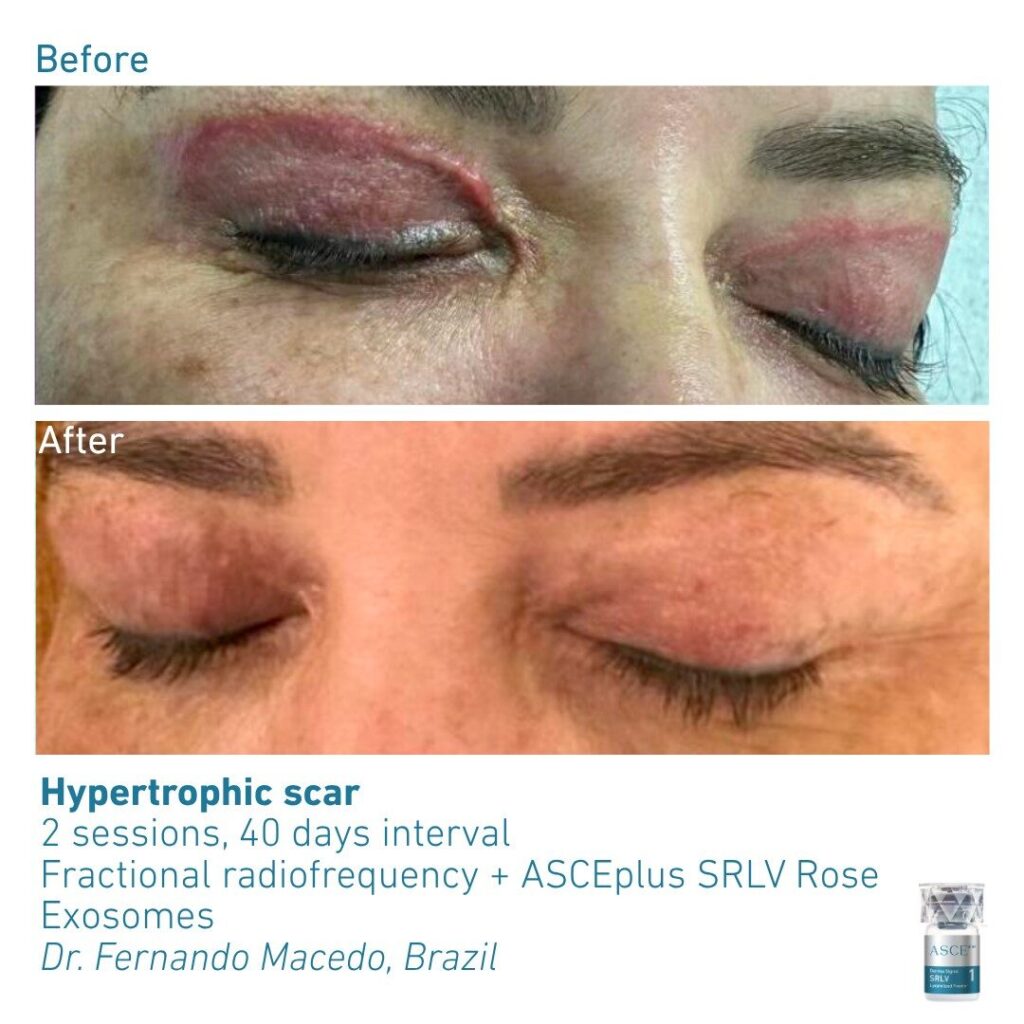 ASCEplus SRLV B&A Hypertrophic Scar