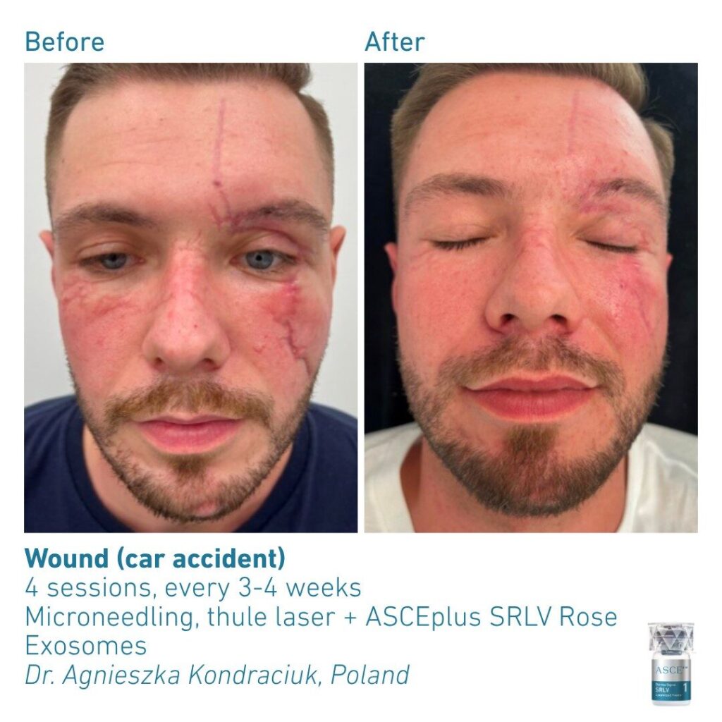 ASCEplus SRLV B&A Wound