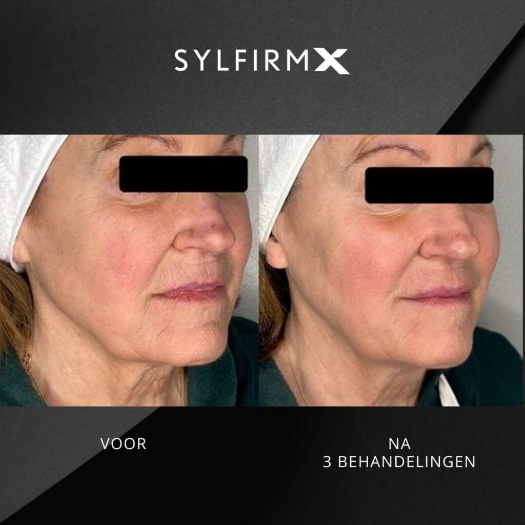 Voor- en nafoto RF-microneedling