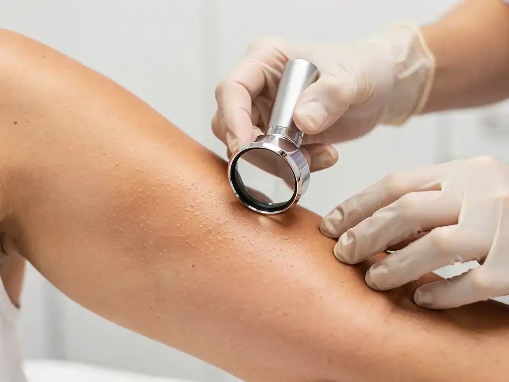 Dermatologisch onderzoek van bovenarm met vergrootglas door gehandschoende handen in klinische setting