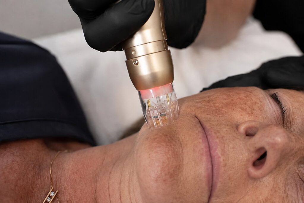 RF-microneedling met Sylfirm X bij melasma