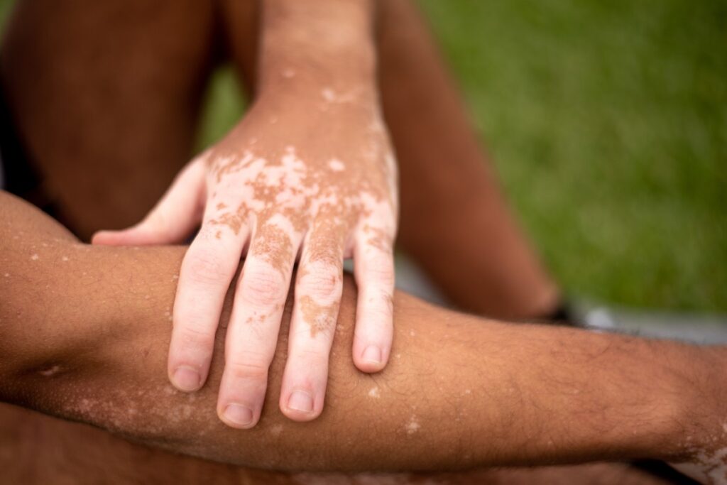 Arm en hand met vitiligo